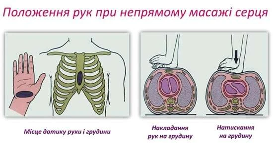Серцево-легенева реанімація у разі нещасного випадку на виробництві